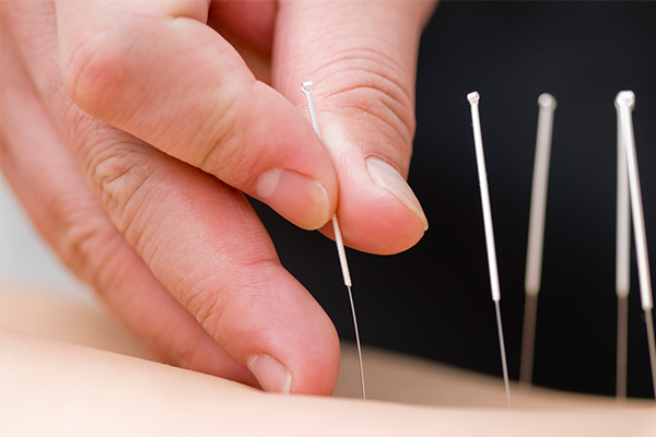 get acupuncture done from a professional to aid in bursitis relief