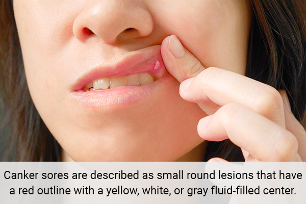 how to know if you have canker sores?