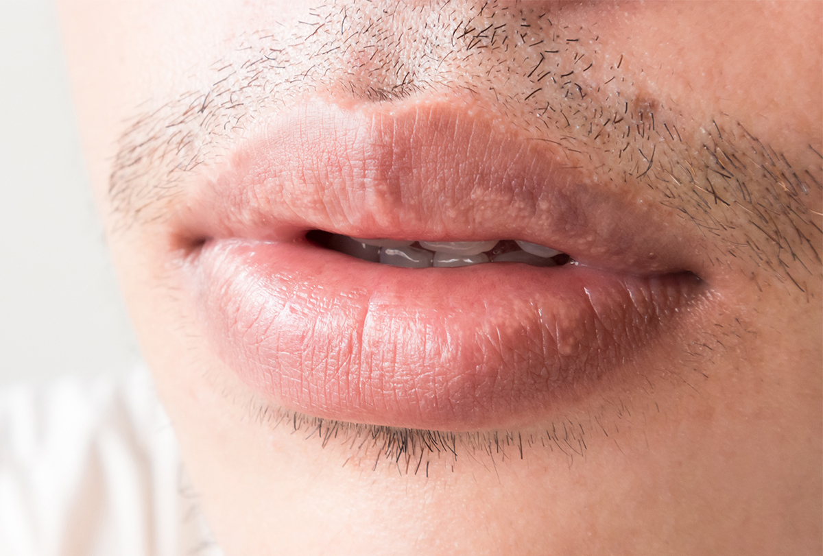 fordyce-spots-on-the-lips-causes-symptoms-treatment