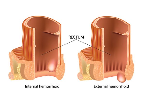 signs and symptoms of hemorrhoids