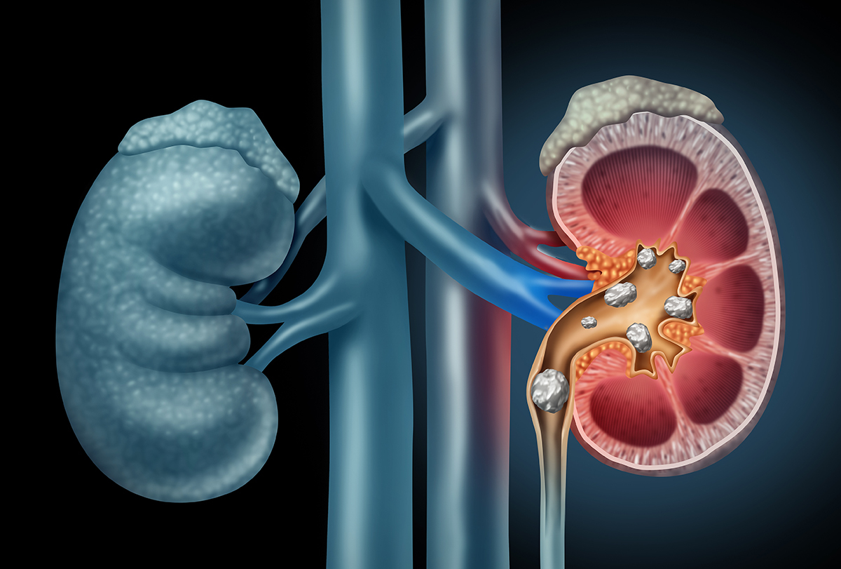 kidney stones: causes, signs, and treatment options