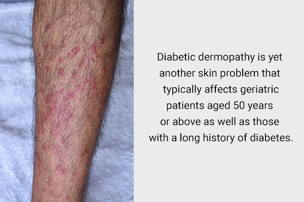 diabetic dermopathy is a diabetes-related skin condition