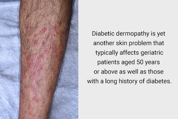 Diabetes Skin Problems Pictures