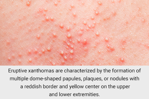 eruptive xanthomas is a skin condition associated with diabetes