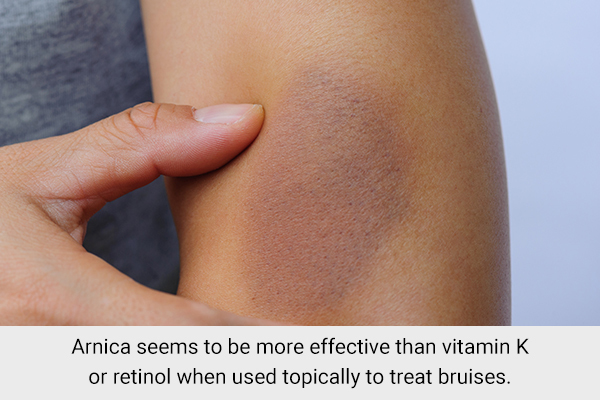arnica application has been proven to heal bruises