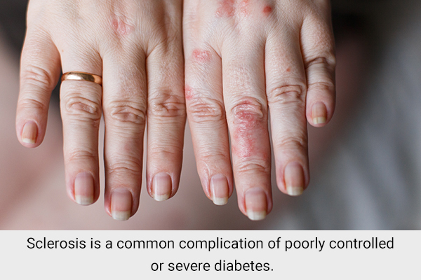 sclerosis is a common complication of poorly controlled/severe diabetes