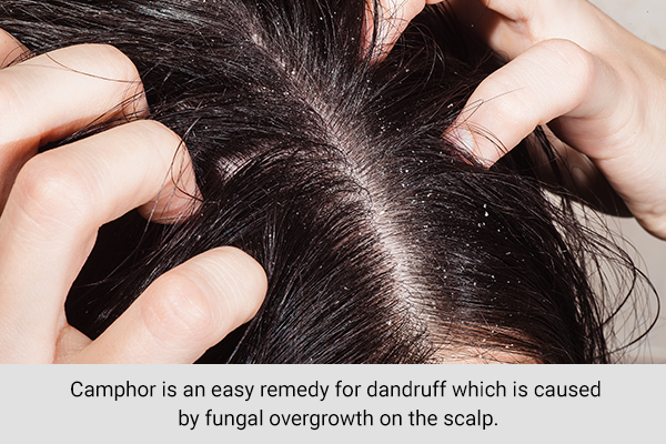 camphor is an easy dandruff remedy for your scalp and hair