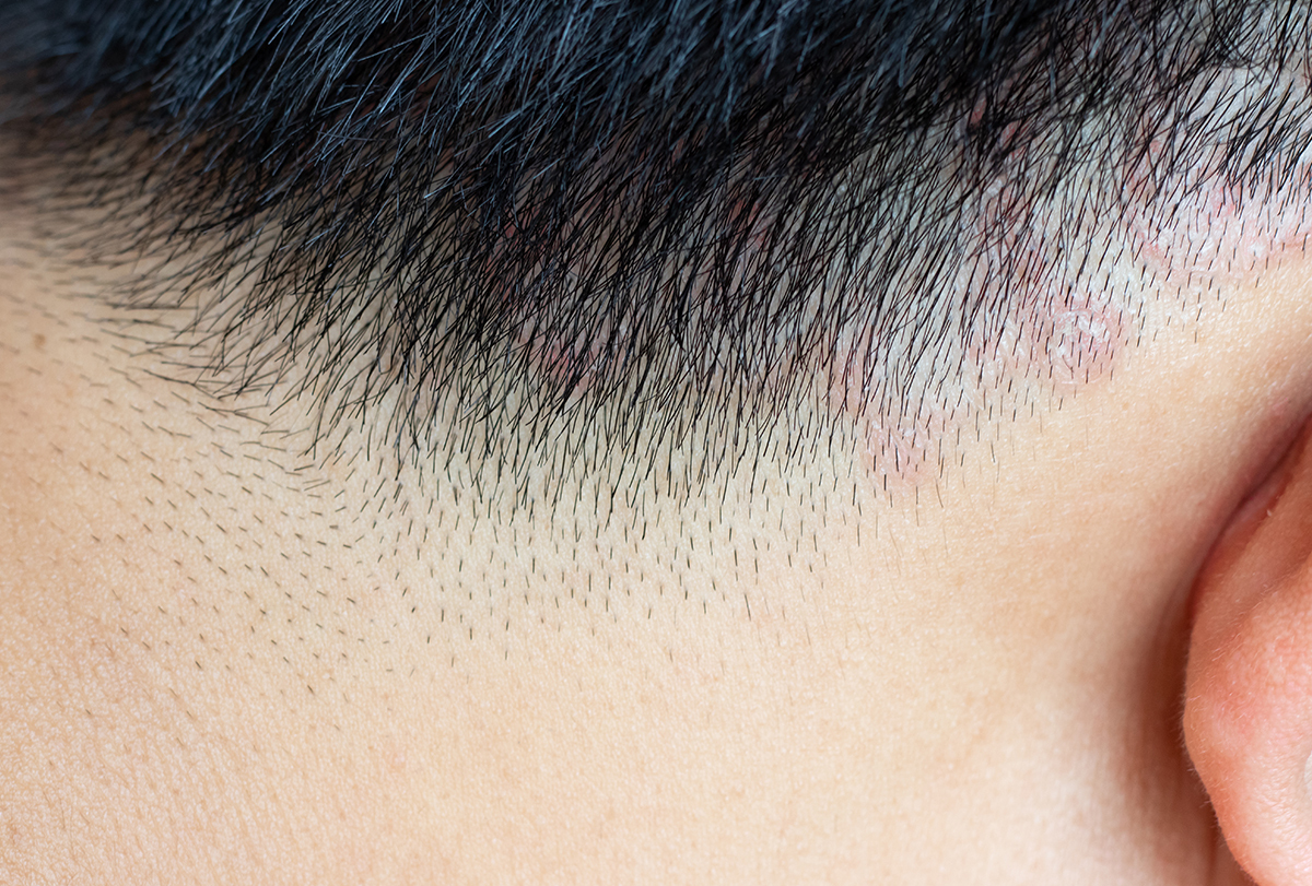 ringworm of the scalp: causes, signs, and treatment