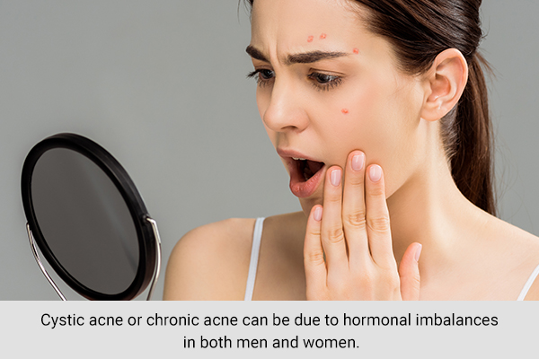 chronic acne is also a symptom of hormonal imbalances