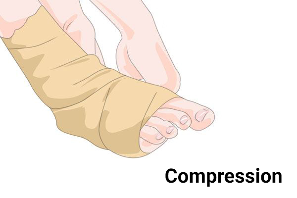compressing the injured area can help reduce the swelling