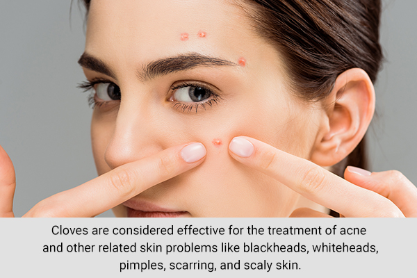 cloves can be an effective treatment for acne