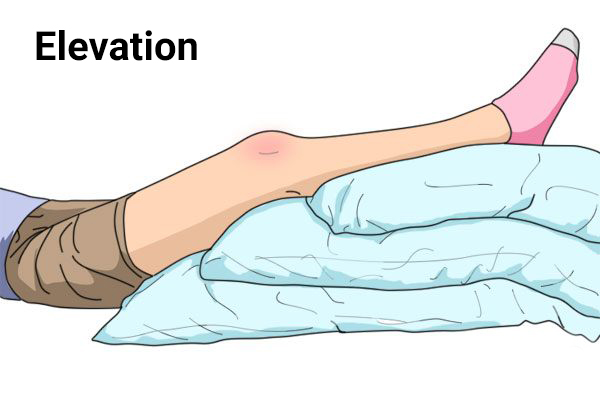 elevating the injured area can help reduce swelling from an injury