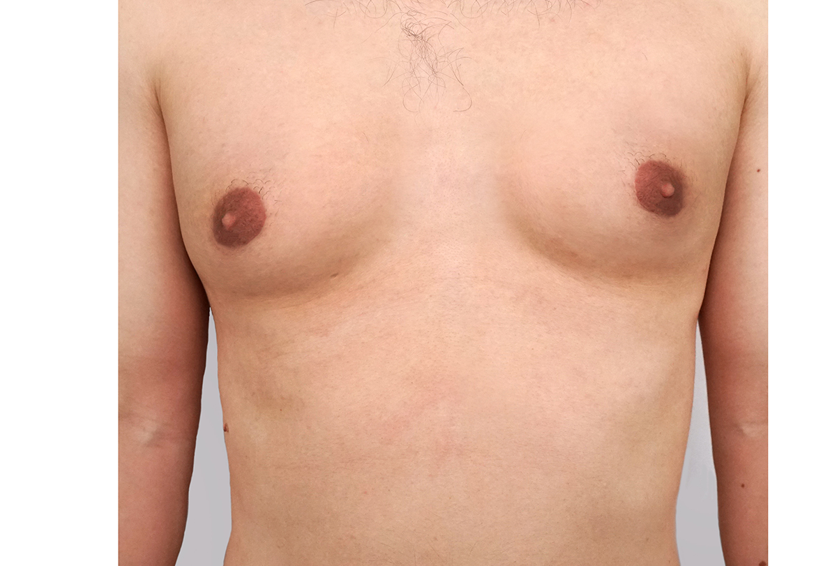 gynecomastia: causes, signs, and home remedies