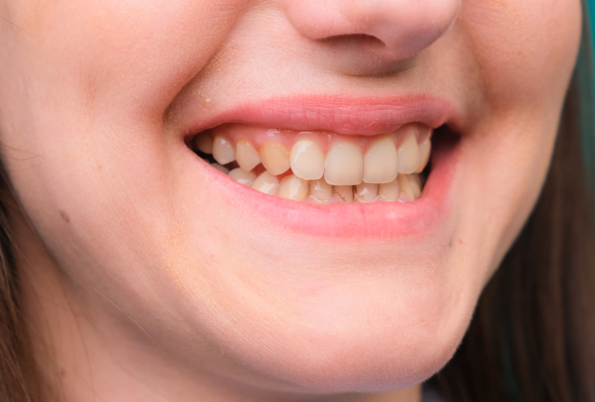 home remedies to whiten yellow teeth naturally