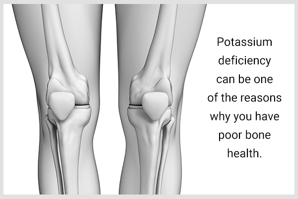 骨骼健康状况不佳是缺钾的征兆