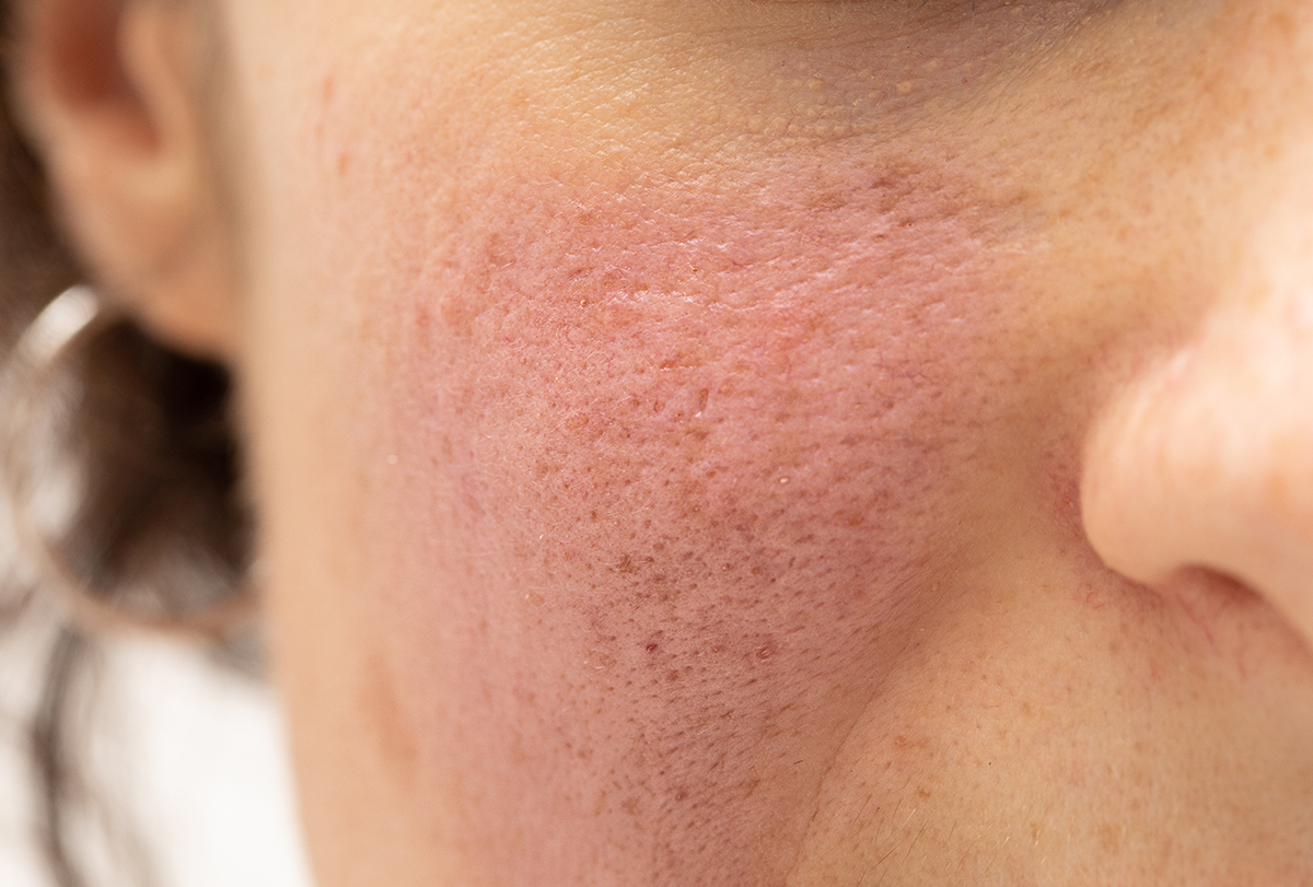 redness on face after applying ice: causes and ways to fix
