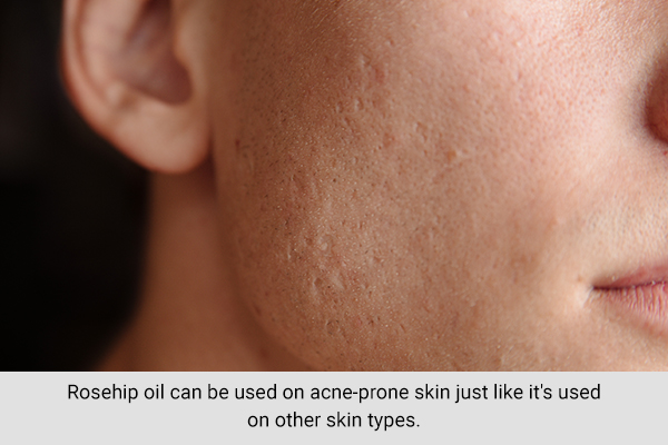 how to use rosehip oil to deal with acne-prone skin?