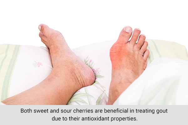 consuming sweet and sour cherries can lower risk of gout attacks