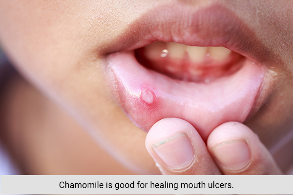 chamomile is good for healing mouth ulcers