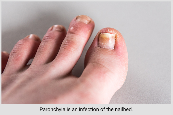 nail infection (paronchyia) can also lead to sore big toe