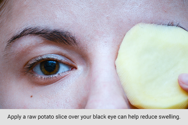 placing raw potato over your eyes may reduce black eye swelling