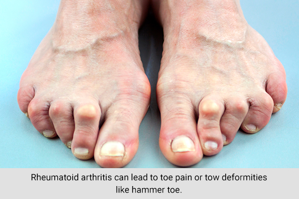 rheumatoid arthritis can also lead to big toe pain