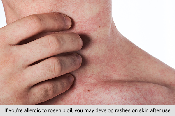 side effects of rosehip oil application on skin