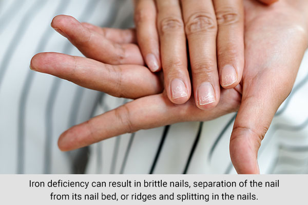 iron deficiency may lead to brittle nails