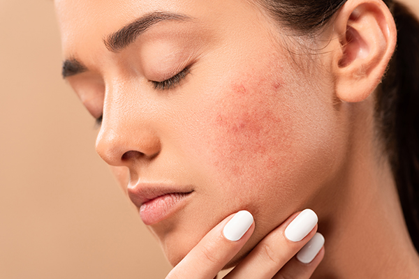 can you use face oils for acne management?