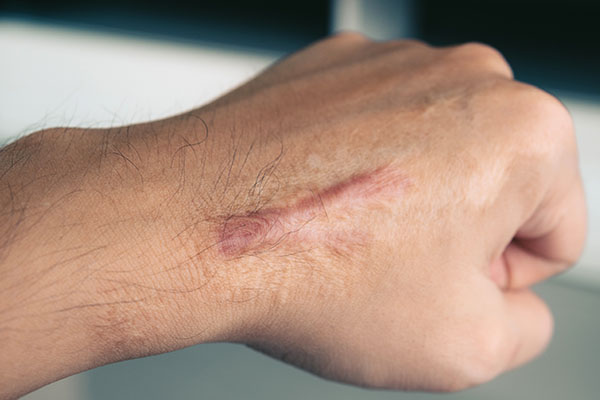can scars fade away on their own?