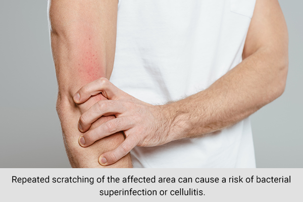 avoid scratching the area affected by bedbugs