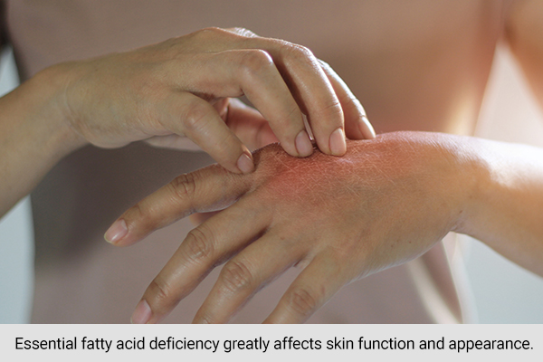 dry skin/poor skin health is a sign of omega 3 fatty acid deficiency