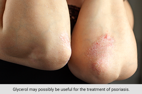 glycerol can be helpful in treating psoriasis