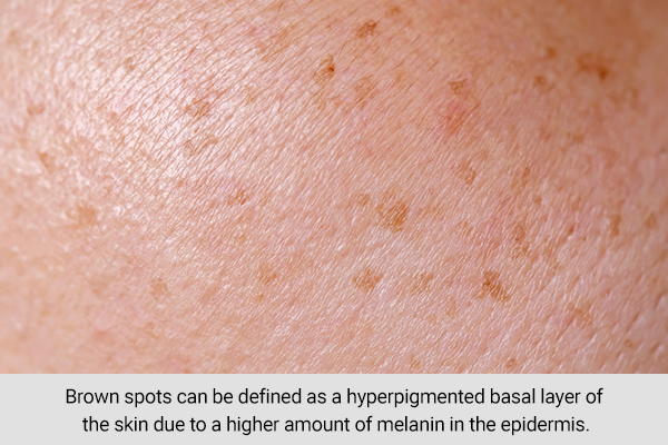 how dark spots are different from normal skin spots?