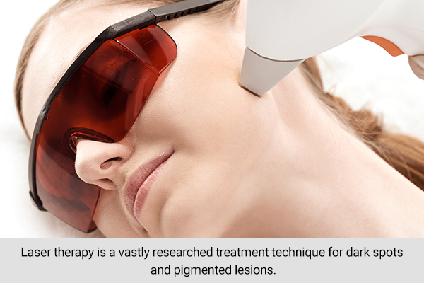 laser therapy is a widely researched and popular treatment for dark spots