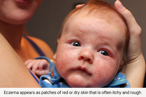 signs and symptoms indicative of eczema in children