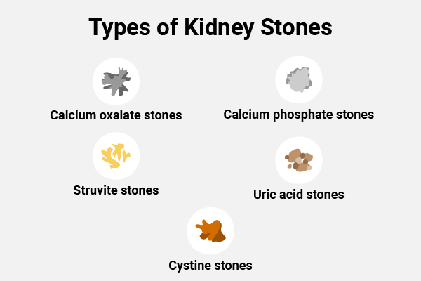 calcium phosphate stones