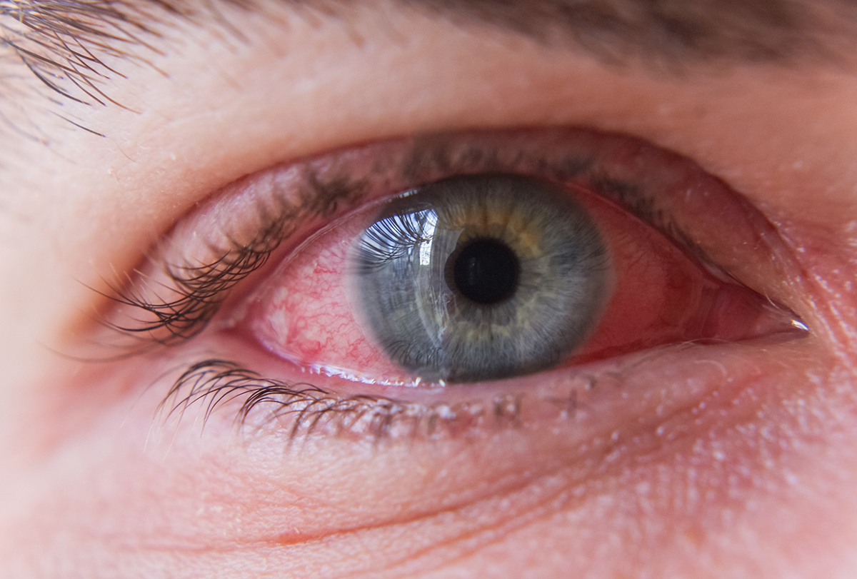 Causes Of Red Sclera