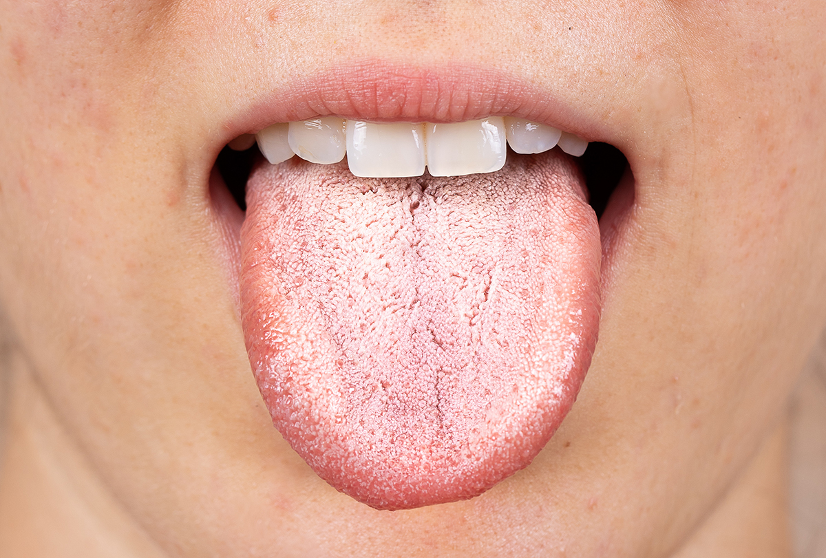 oral thrush: causes, signs, and treatment