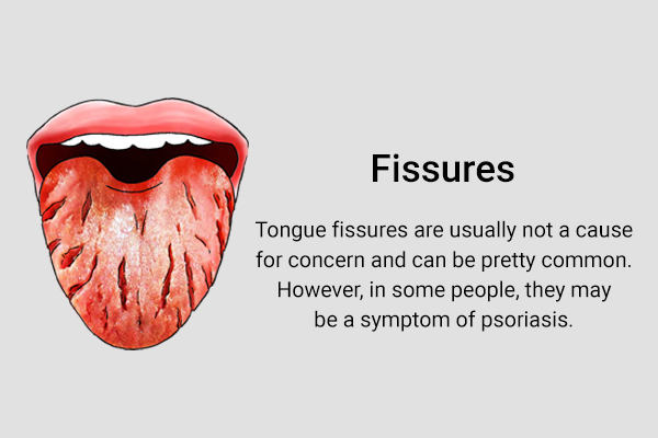 tongue fissures in some people could be indicative of psoriasis
