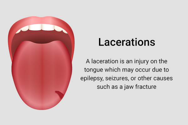 lacerations on the tongue can be due to epilepsy, seizures, or other causes