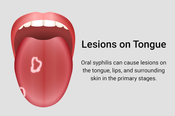 lesions on the tongue could be indicative of oral syphilis