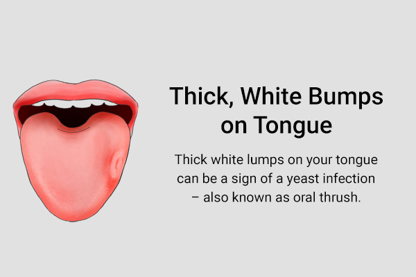 lumpy white bumps on tongue can indicate yeast infections