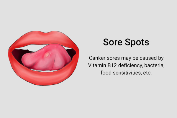 sore spots (canker sores) can indicate vitamin b12 deficiency, food sensitivity, etc.