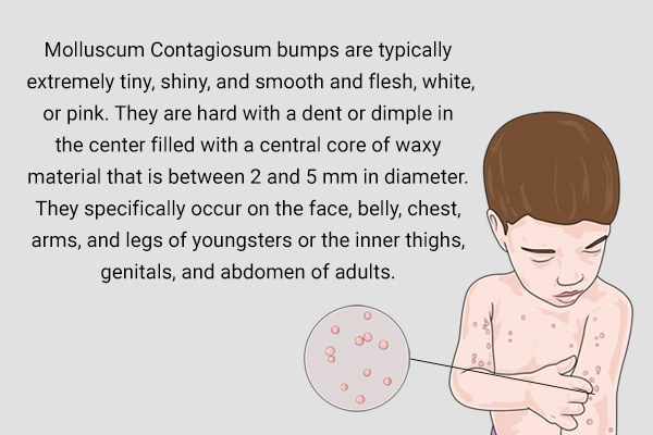 Molluscum Contagiosum Causes Symptoms And Treatment 8257