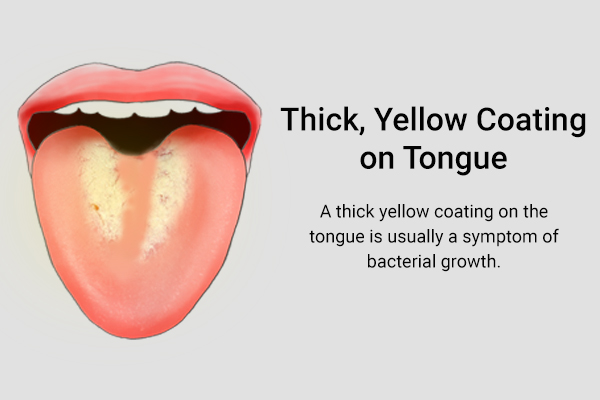 a thick yellow coating on tongue is usually a sign of bacterial overgrowth