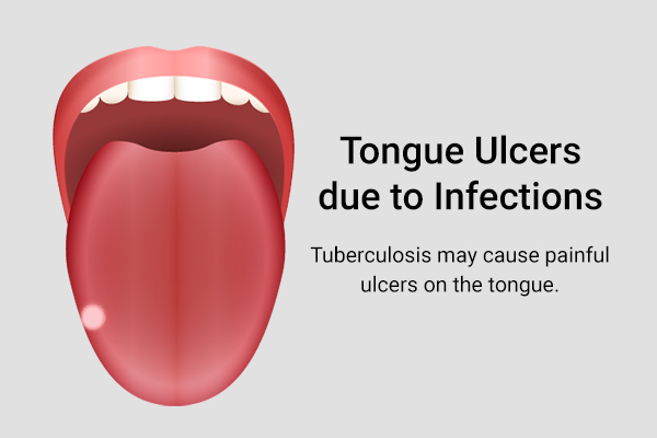 ulcers on the tongue could indicate tuberculosis