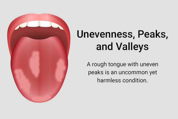 a rough tongue with unevenness, peaks is a common but harmless condition