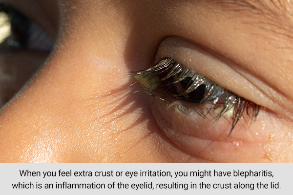 eye gunk can be indicative of crusty eyes/blepharitis