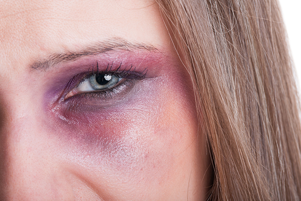 how long does it take for black eye to heal?